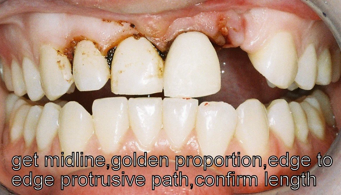 Dental plaster model with a ceramic tooth