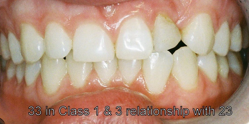 Close-up of human teeth showing bite alignment and dental health