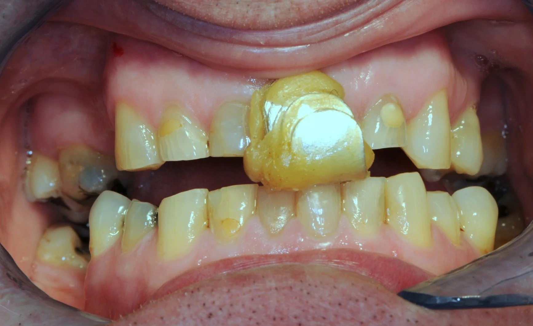 Close-up of yellowed, decayed teeth with a broken crown and cavities.