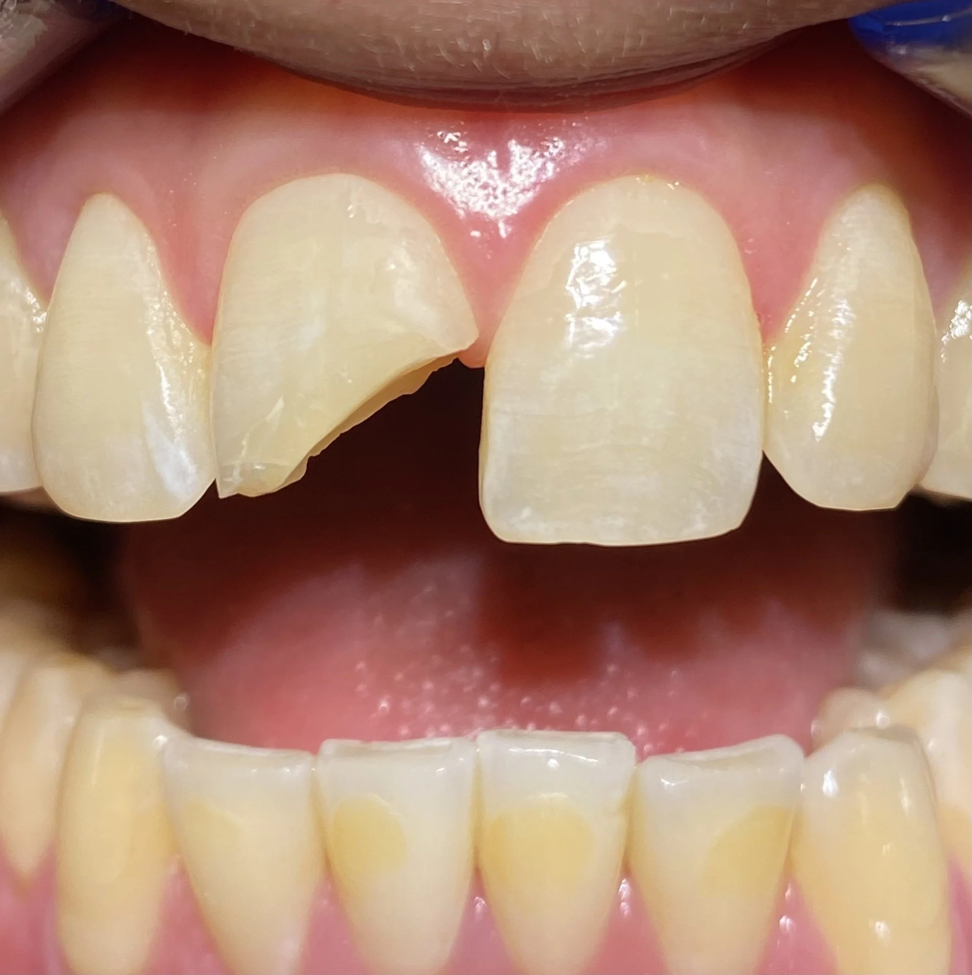 Close-up of a person's front teeth, showing a chipped upper central incisor.