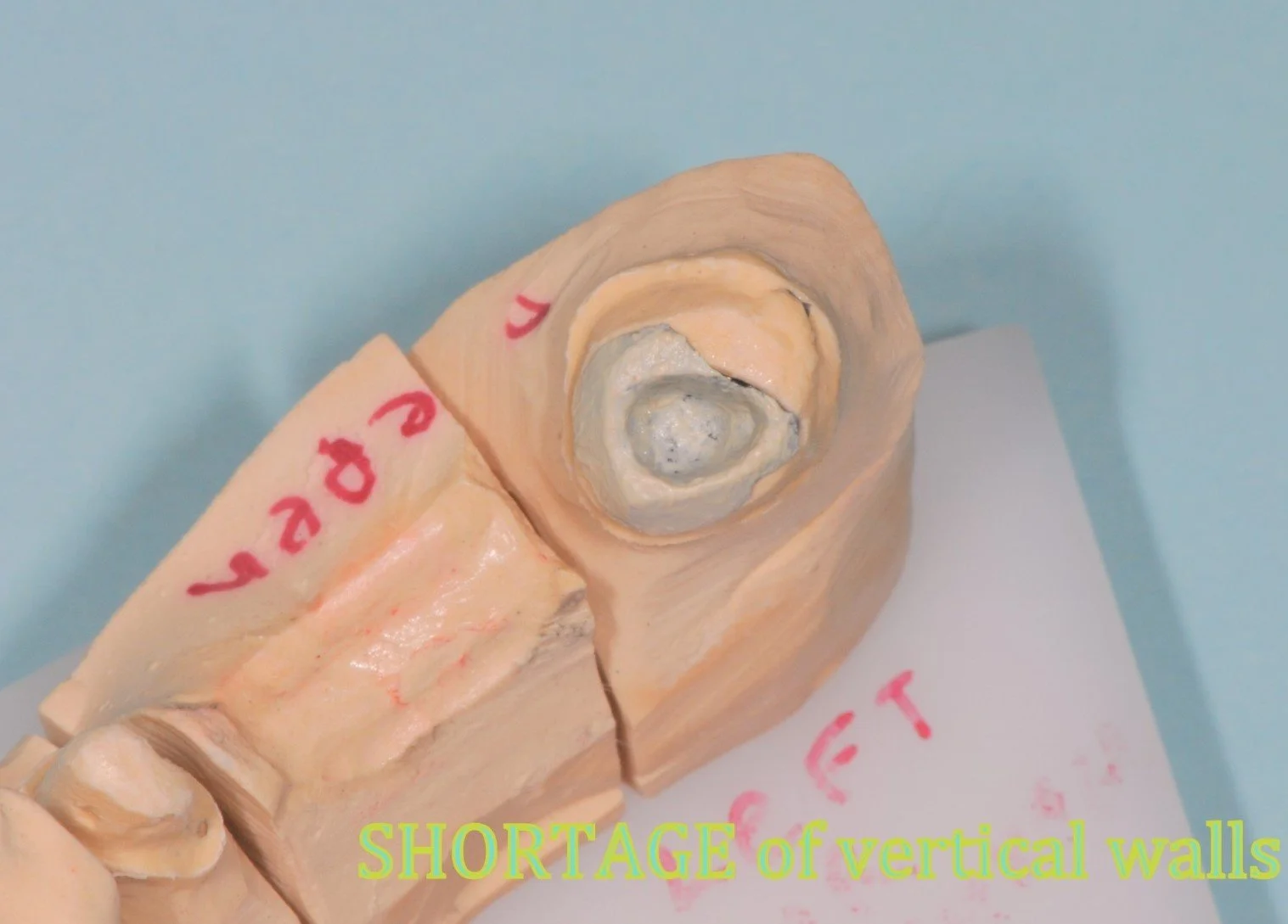 Dental impression model with labeled sections, highlighting a shortage of vertical walls note.