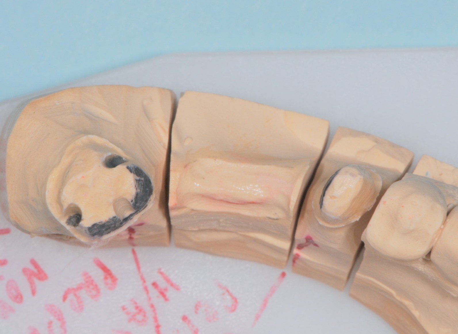 Dental model with several teeth, including one with endodontic access, used for educational purposes.