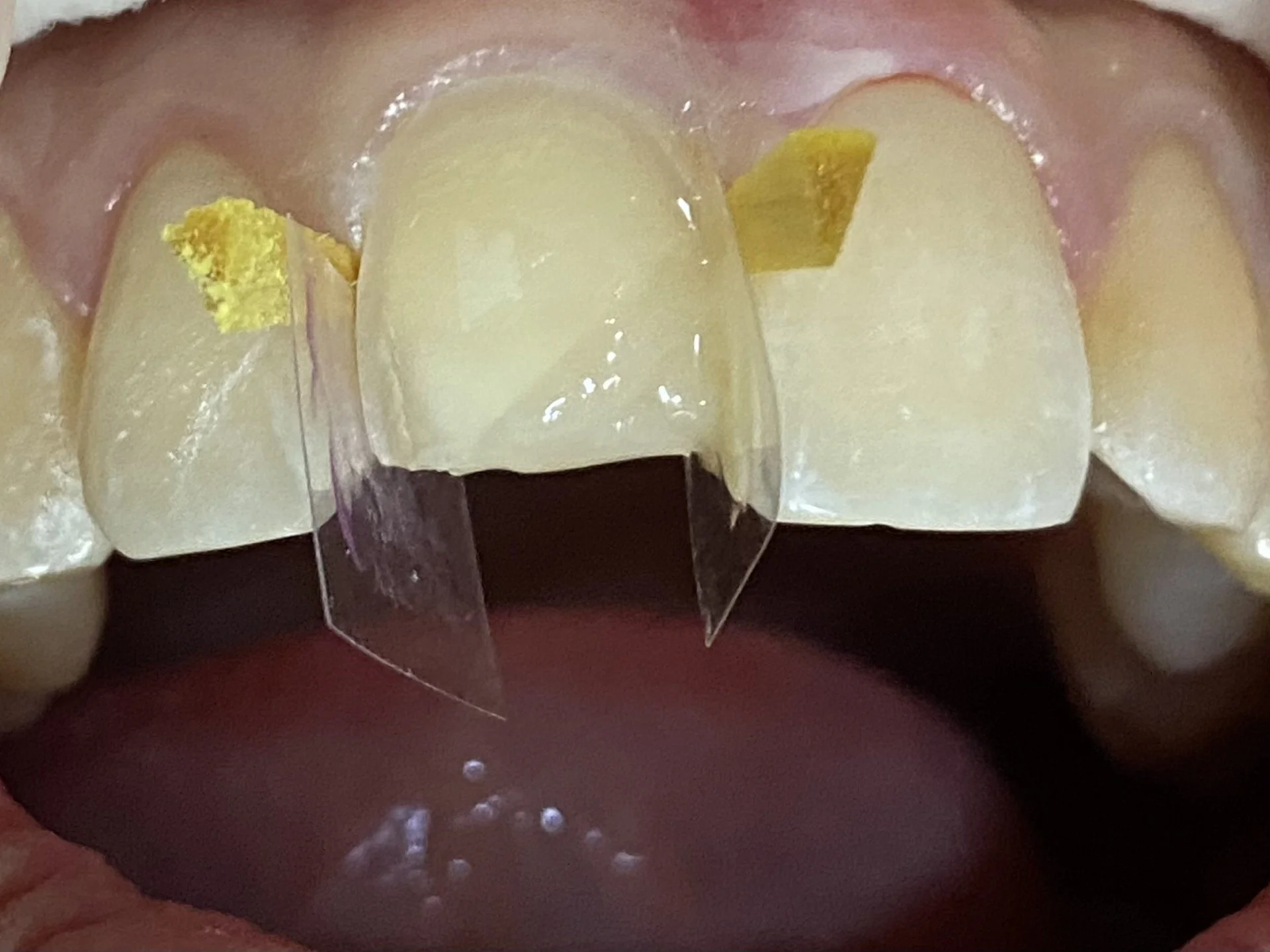 Close-up of human teeth with wedges and a matrix band for dental restoration work.