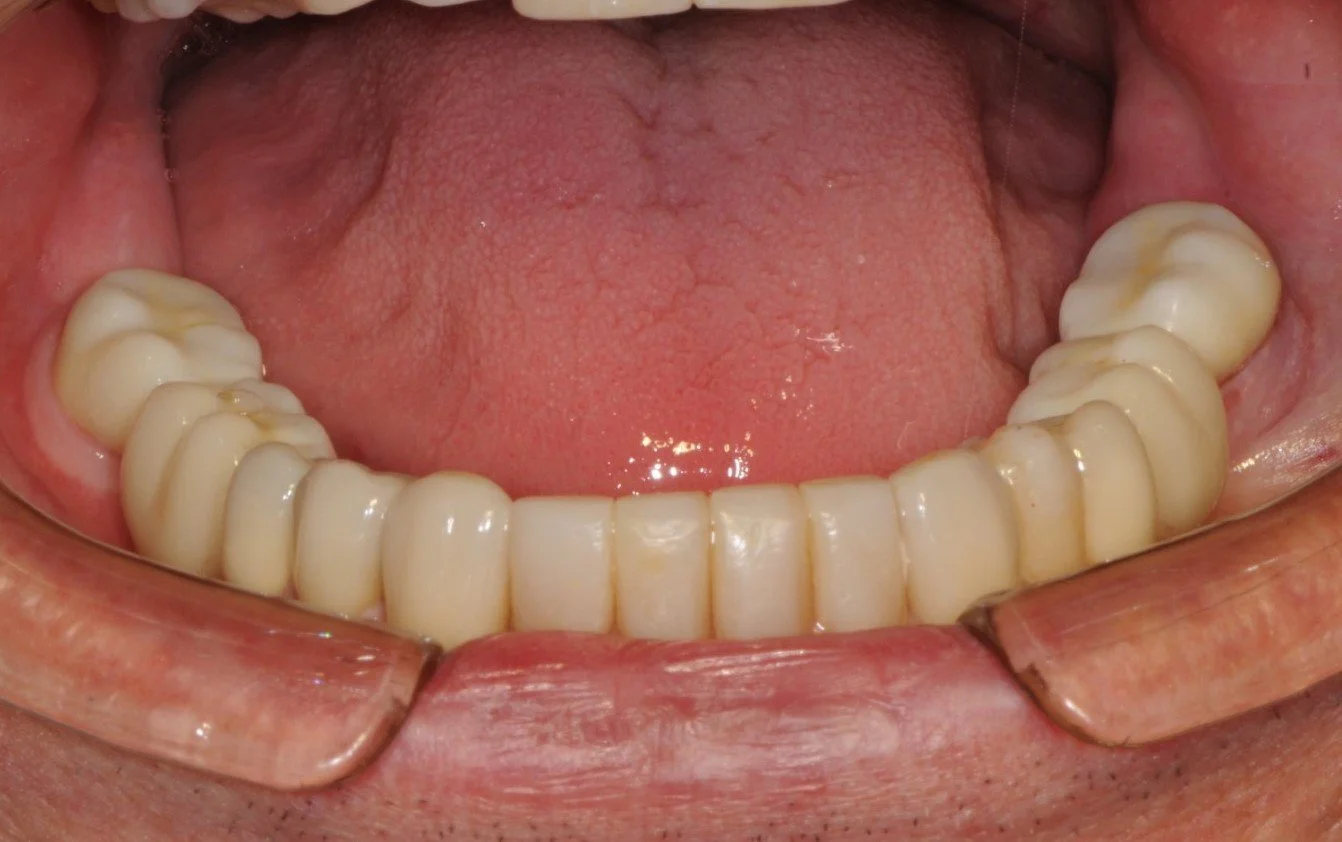 Close-up of a person's lower dental prosthesis with visible gums and tongue.