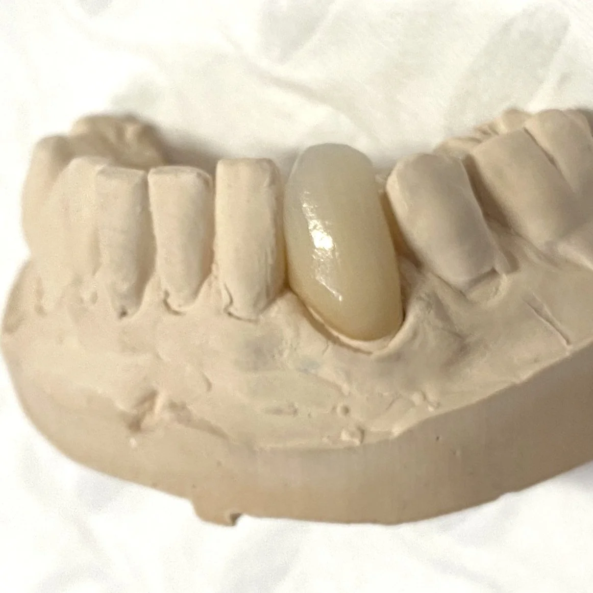 Dental mold with prosthetic tooth