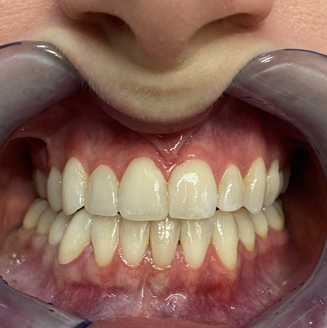 Close-up of dental check-up showing upper and lower teeth