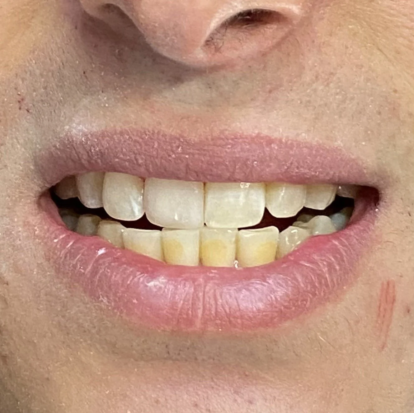 Close-up of a smiling person's teeth with slightly stained upper and lower teeth, visible lips and part of the nose.