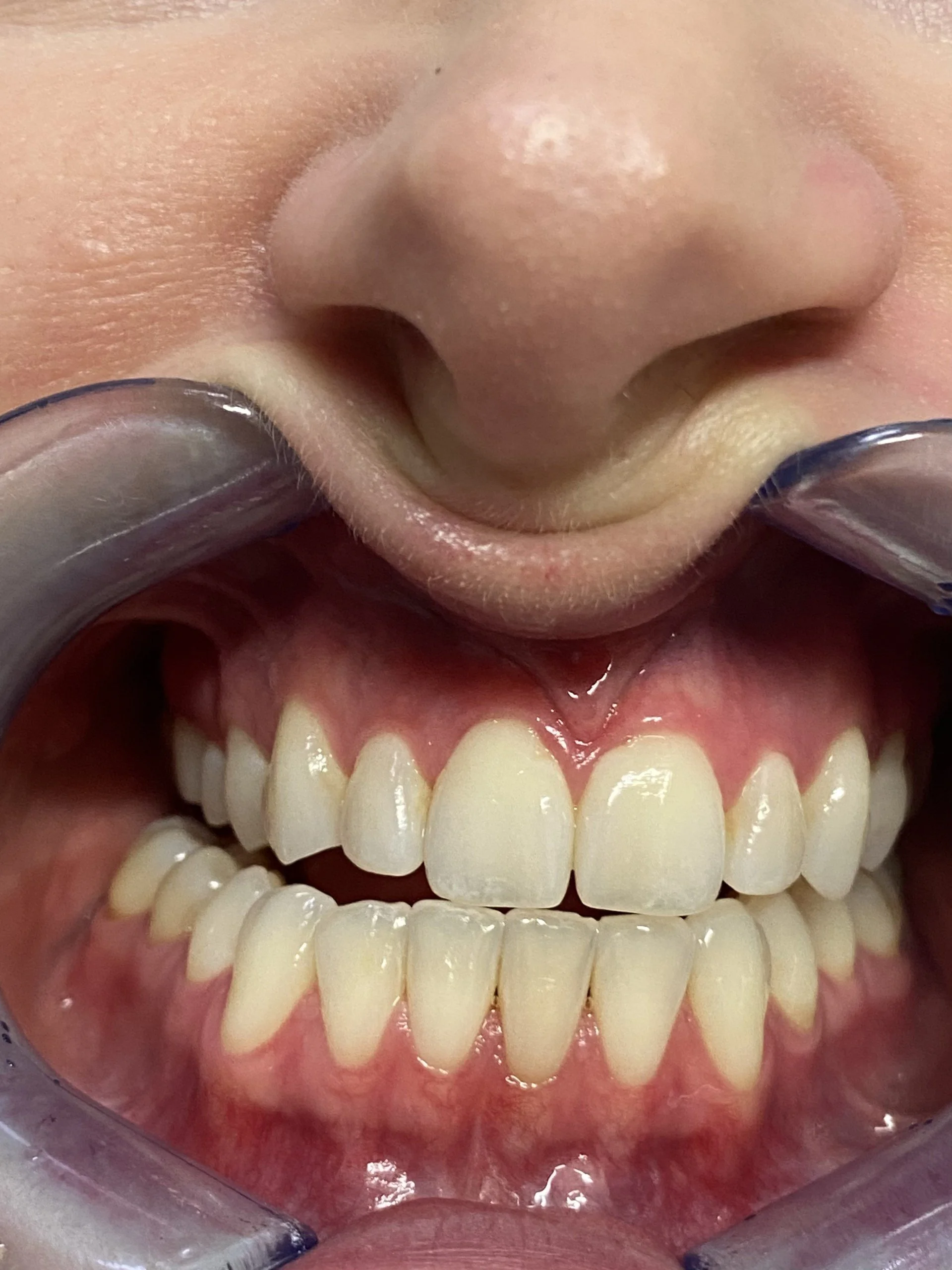 Close-up of a person's mouth with a dental cheek retractor in place, showing upper and lower teeth.