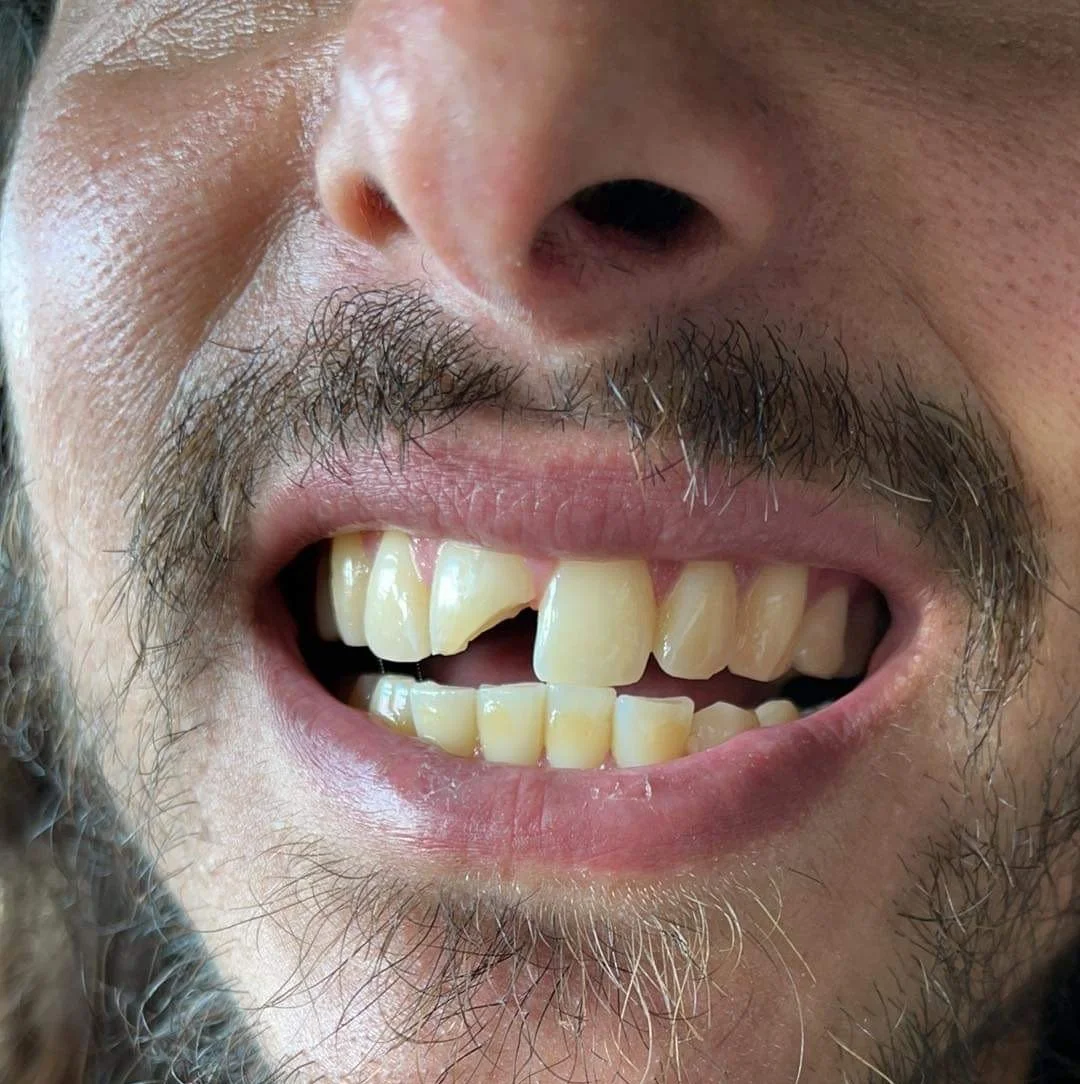 Close-up of a person's mouth showing a chipped front tooth and facial hair.