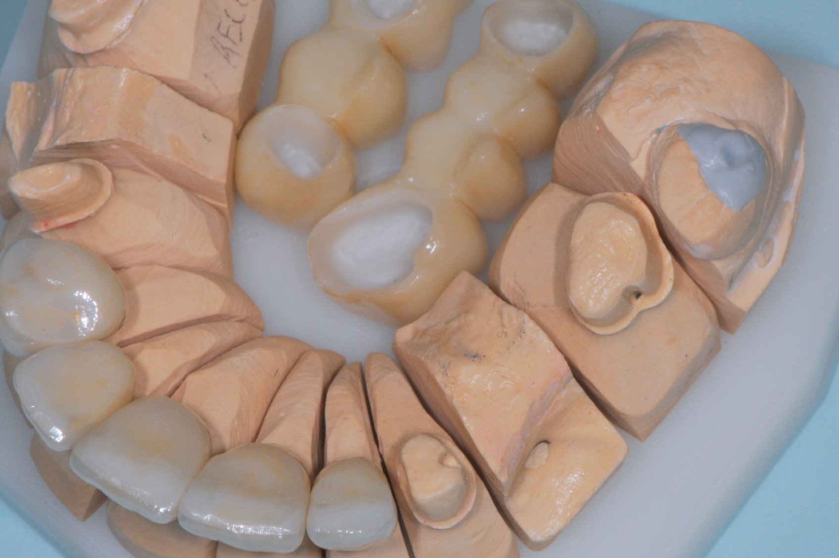 Dental models and crowns on a plaster mold for dental restoration.