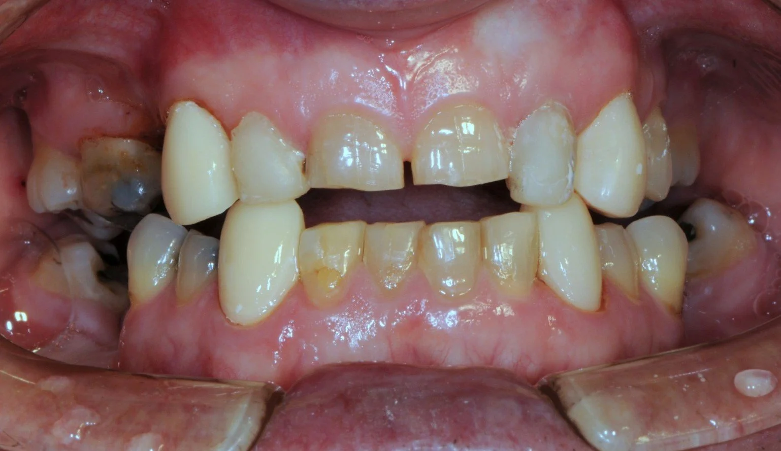 Close-up of human teeth with dental issues, including decay and gum discoloration.