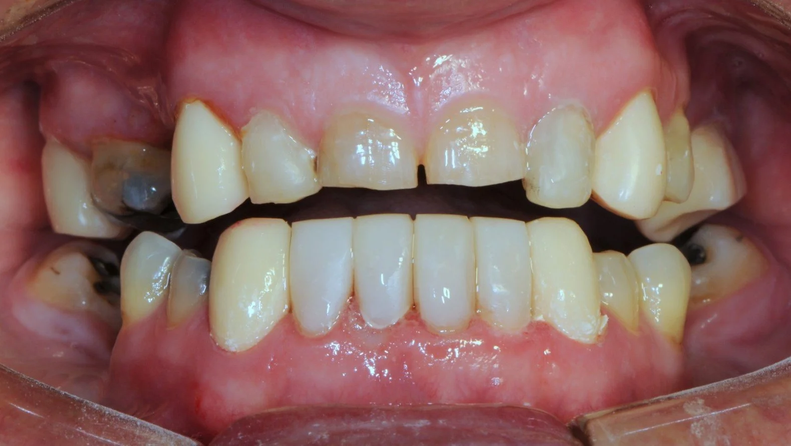 Close-up of dental issues, including decayed and discolored teeth, and dental cavities.