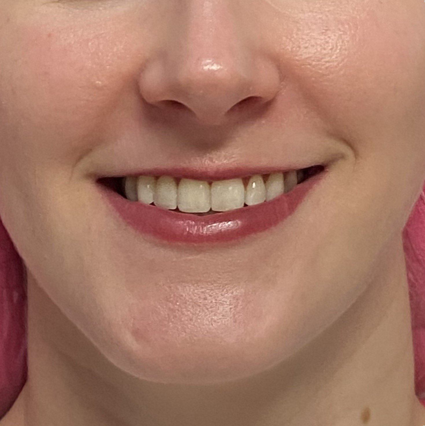 Close-up of a smiling woman's mouth with visible teeth and pink lips.
