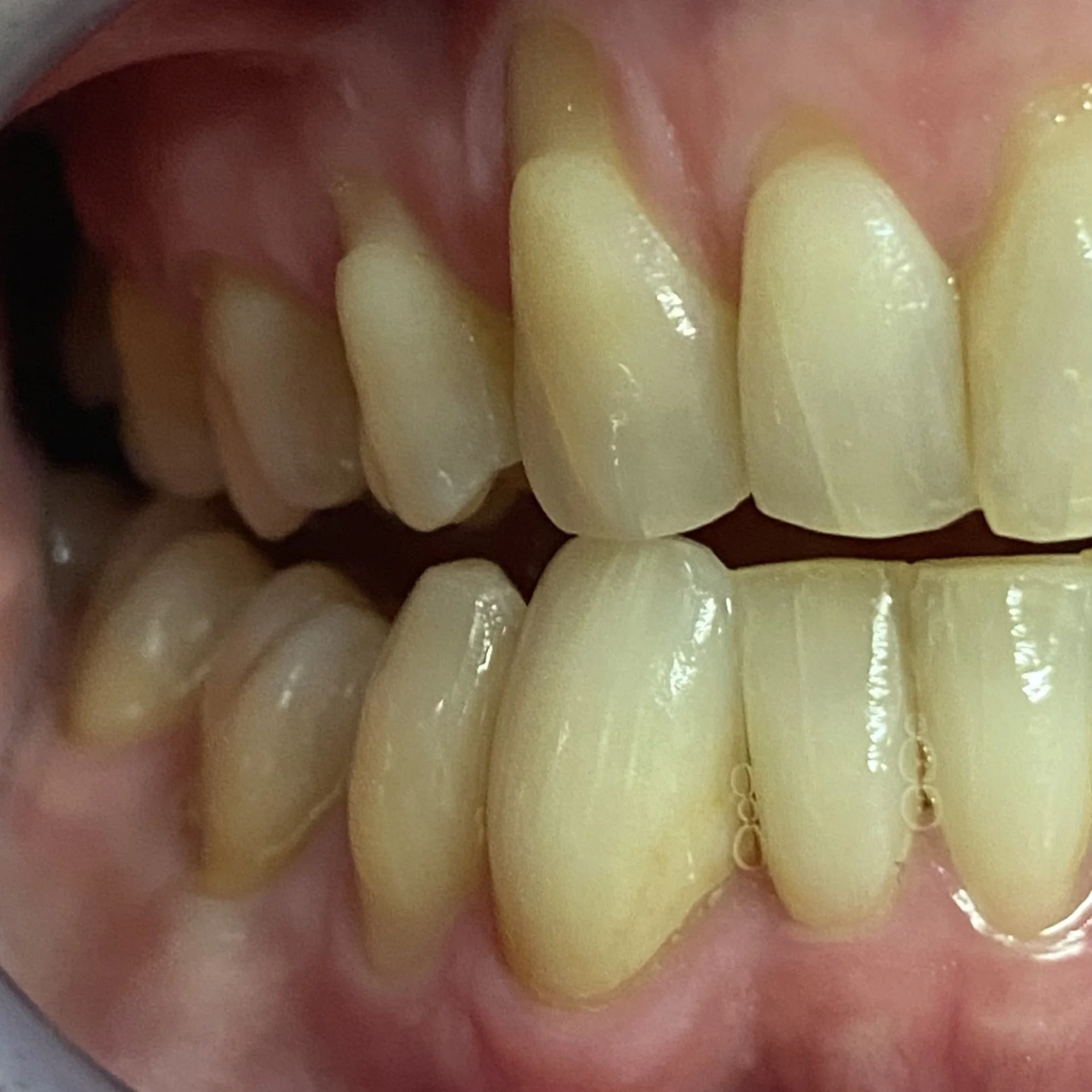 Close-up of a person's teeth and gums showing dental alignment and condition.