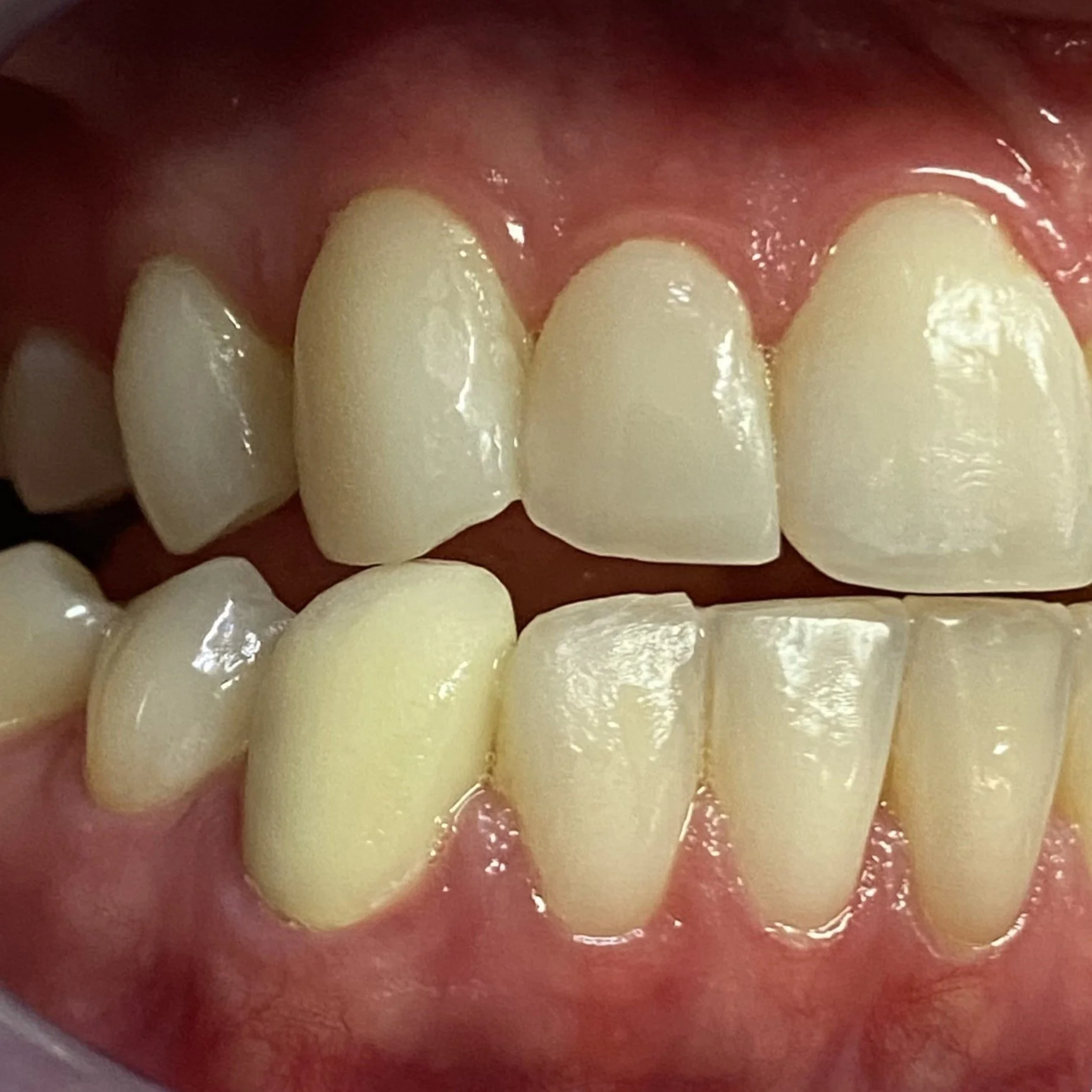 Close-up view of human teeth, showing an overbite.