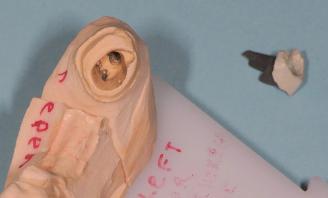 Close-up of a dental model showcasing a tooth preparation with a removable crown nearby on a blue background.
