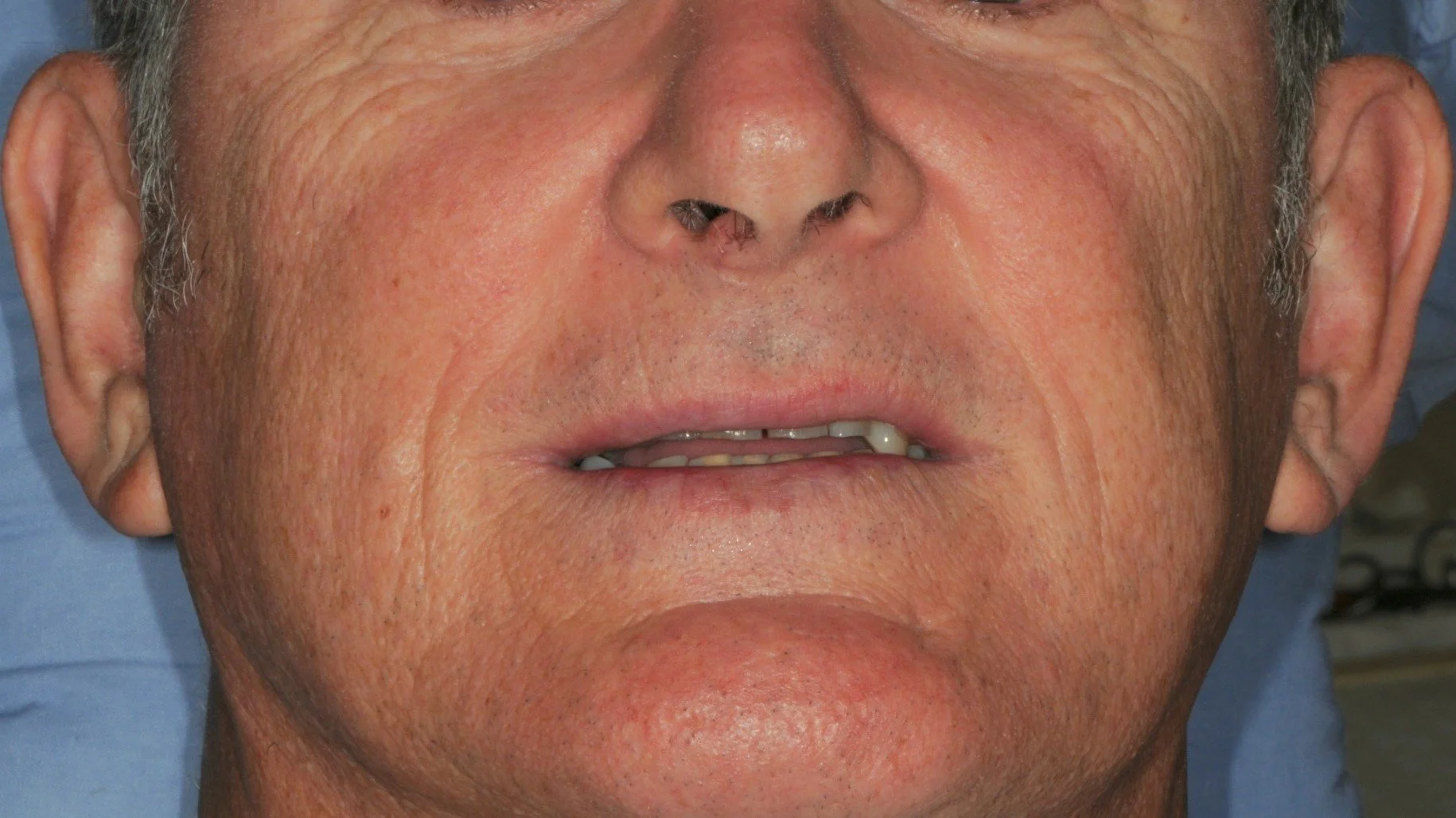 Close-up of an older man's lower face, focusing on lips and chin.
