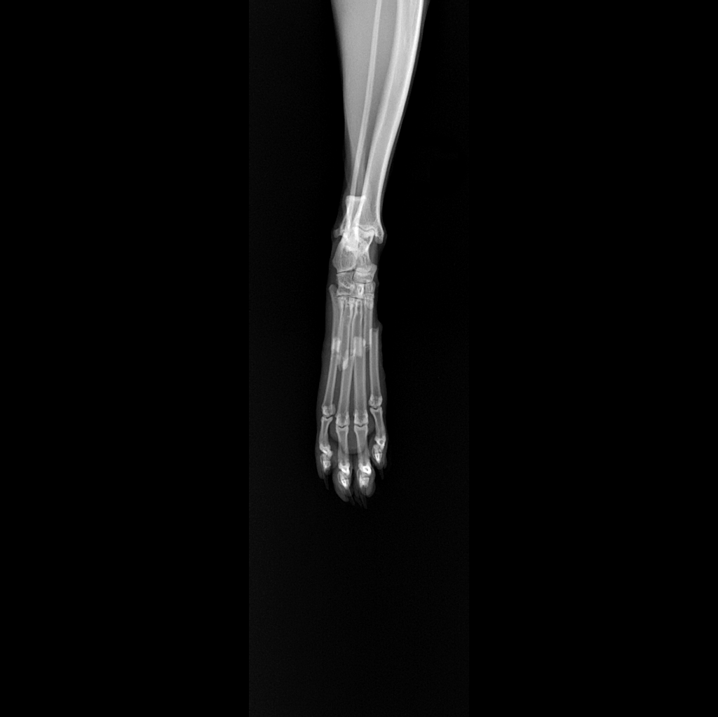 metatarsal fractures.png