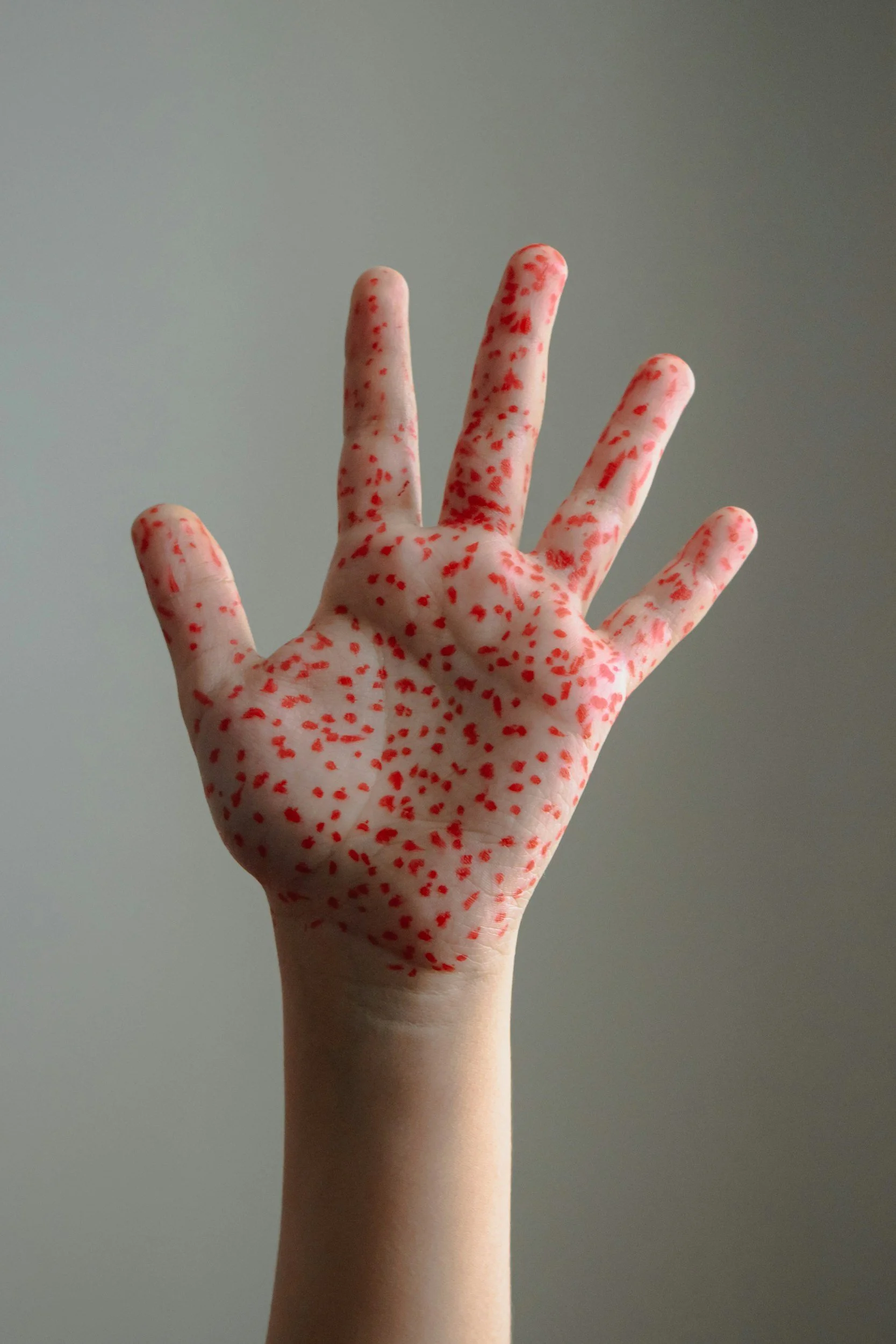 The Measles Resurgence: A Behavioral Failure in Vaccination and Public Health Systems