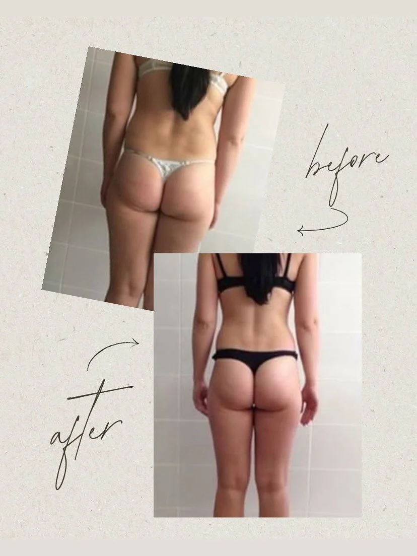 Endospheres therapy: goodbye imperfections!✨

Do you want to get rid of cellulite and achieve a toned figure? Endospheres is your reliable ally in reaching the perfect shape! The procedure effectively combats skin irregularities, reduces volume, and 