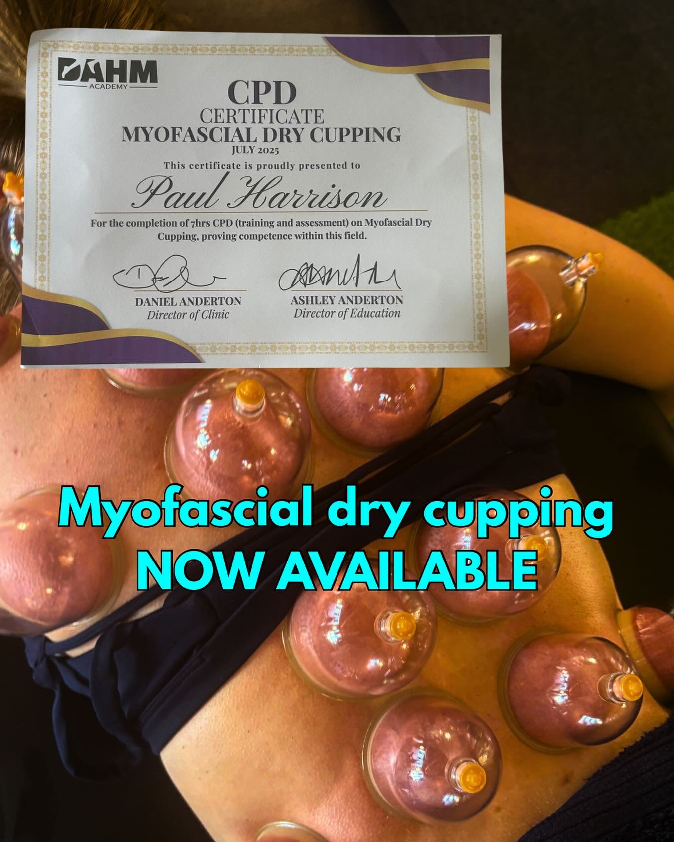 Myofascial Dry Cupping – Now Available
Performance π | Effective πͺ | Recovery π
Benefits:
- Relieves muscle tightness πͺ
- Reduces pain π€
- improves mobilty π€Έ
- Improves blood flow π
- Aids recovery π
- And most importantly looks cool ?