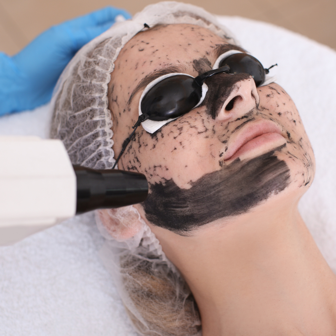 Med Spa in Lyndhurst, OH 44124 | Carbon Peel Facial Near Me
