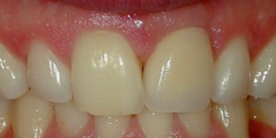 Mask Dental tooth implants