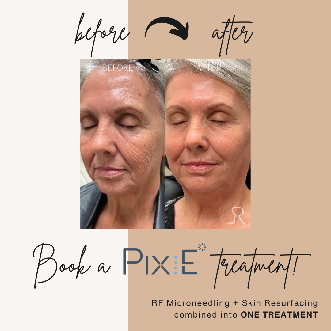 Side-by-side comparison of a woman's face before and after RF microneedling and skin resurfacing treatment, showing significant reduction in wrinkles and improved skin texture.