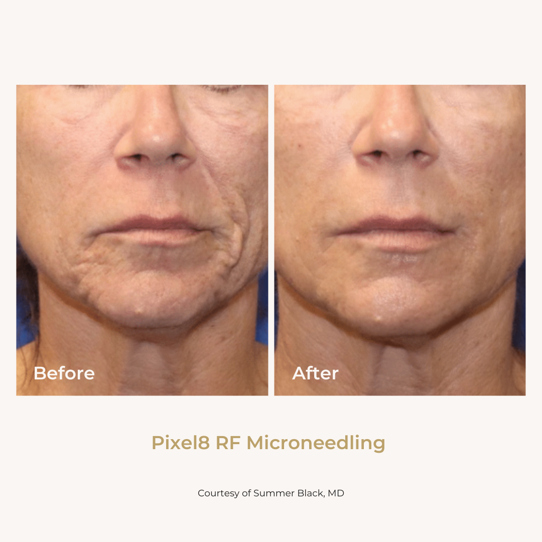 Side-by-side comparison of a woman's face showing before and after skin treatment, with improvements in skin texture and tightness, labeled 'Before' and 'After.' The caption reads 'Pixel8 RF Microneedling,' courtesy of Summer Black, MD.