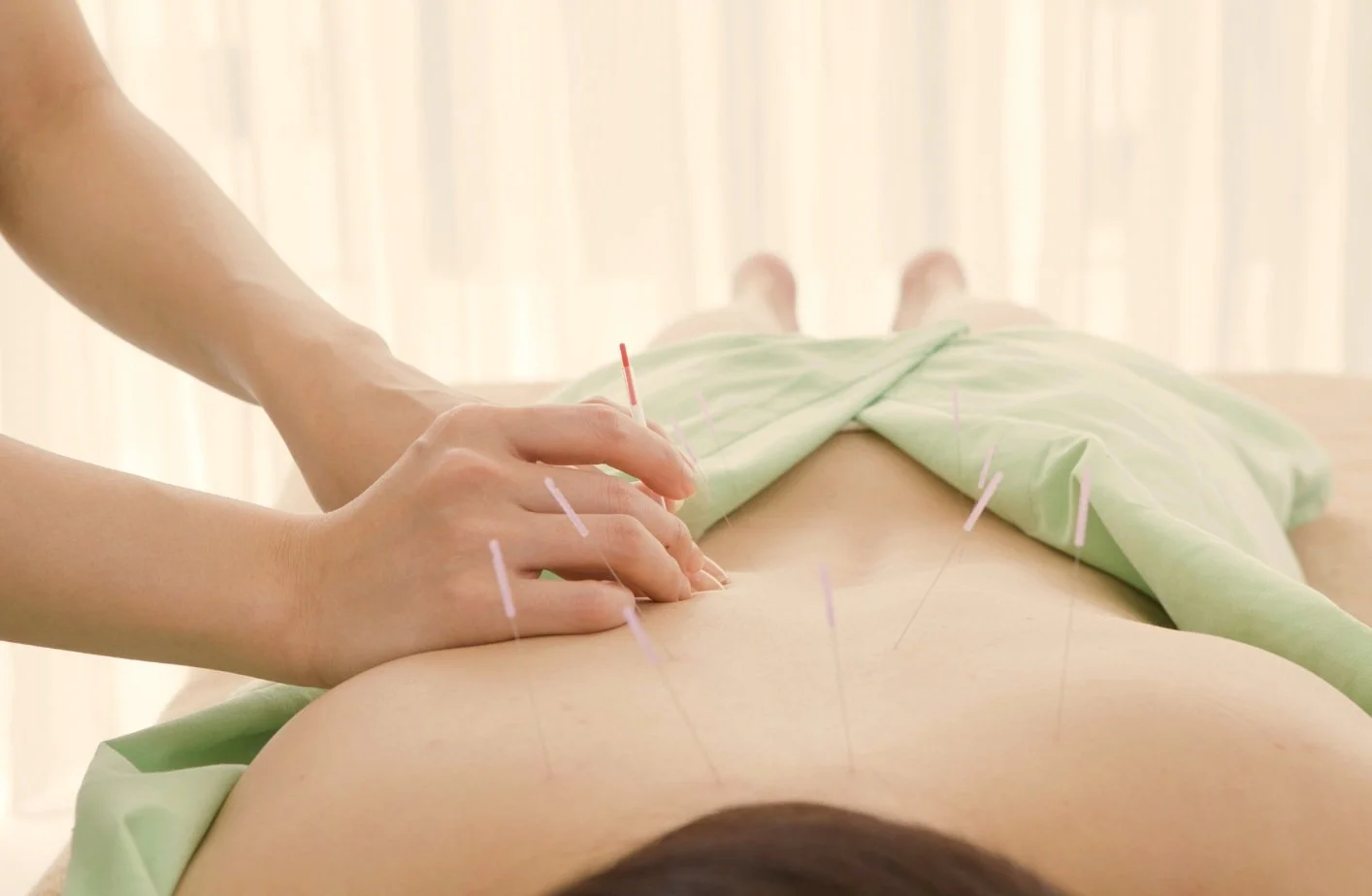 Person receiving acupuncture therapy in clinic treatment rooms with needles inserted in the back, covered partially with a green sheet.
