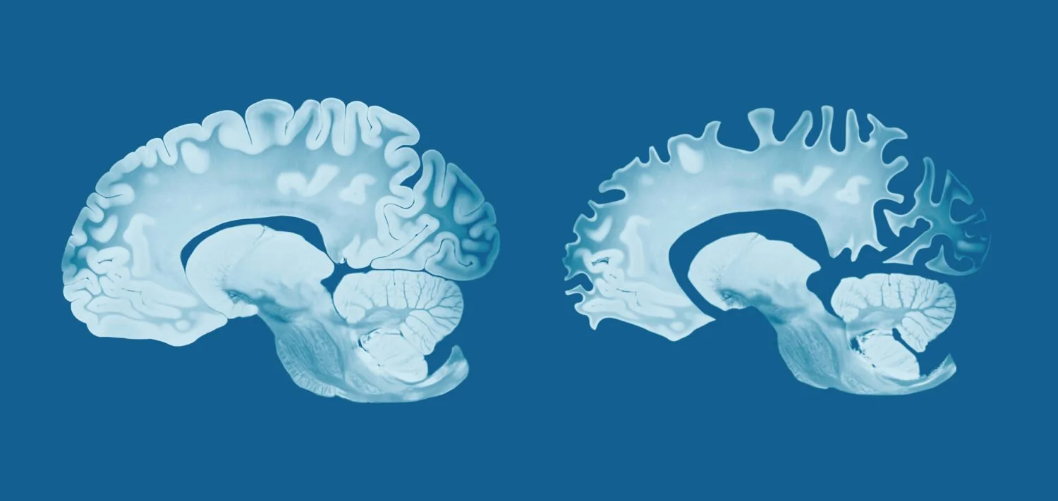 Alzheimer’s Relief: Loss of Brain Protein Eases Alzheimer’s Symptoms and Brain Damage in Mice