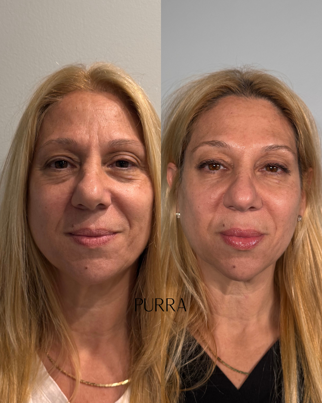 facial balancing before and after at purra medspa, dillsburg pa