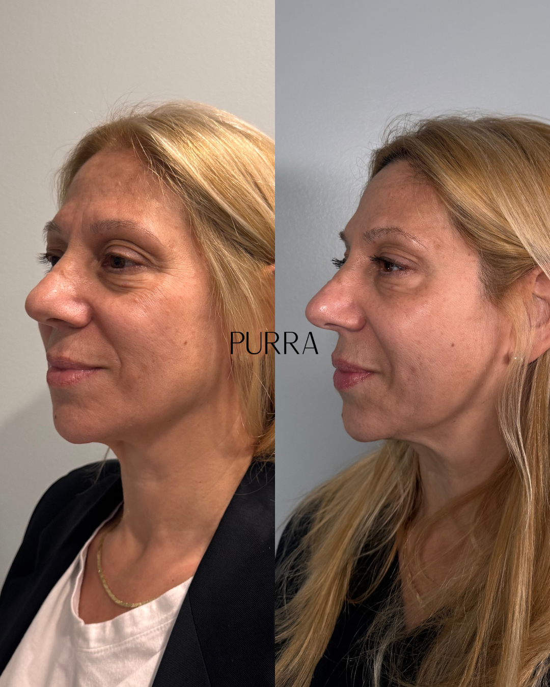 Subtle, natural facial balancing results at Purra MedSpa, Dillsburg PA
