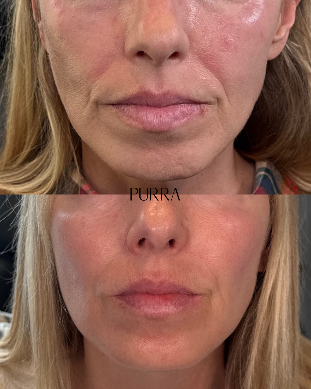 Cheek and midface filler balancing before and after, Dillsburg PA