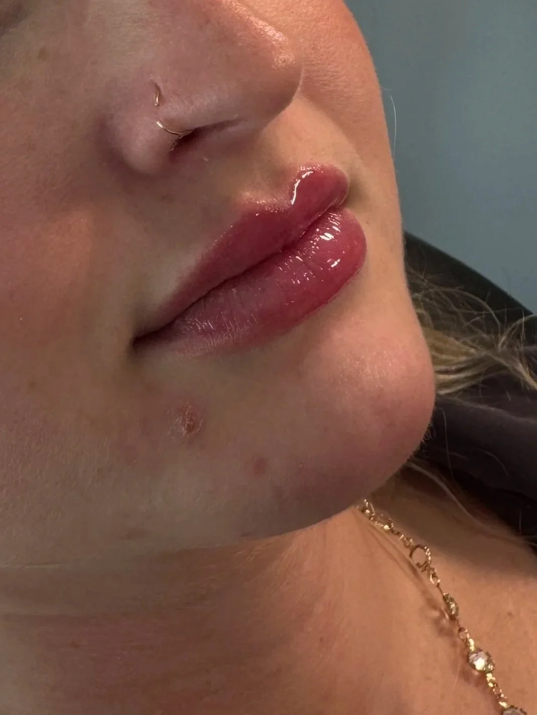 Close-up of natural lip filler results, Purra MedSpa Dillsburg PA
