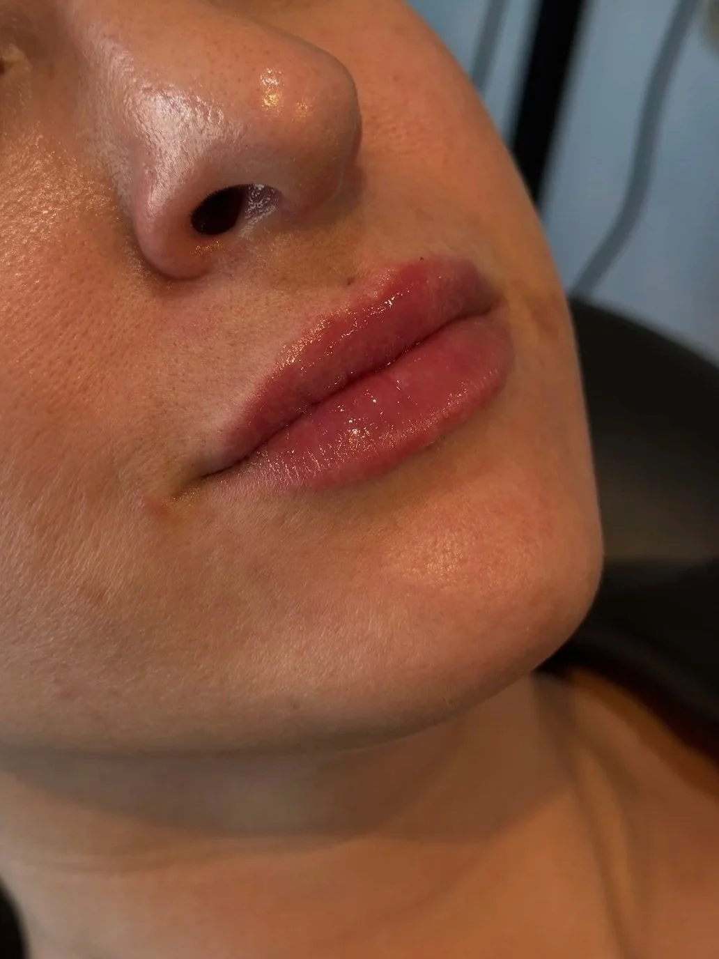 Signature lip filler results at Purra MedSpa near Harrisburg, PA