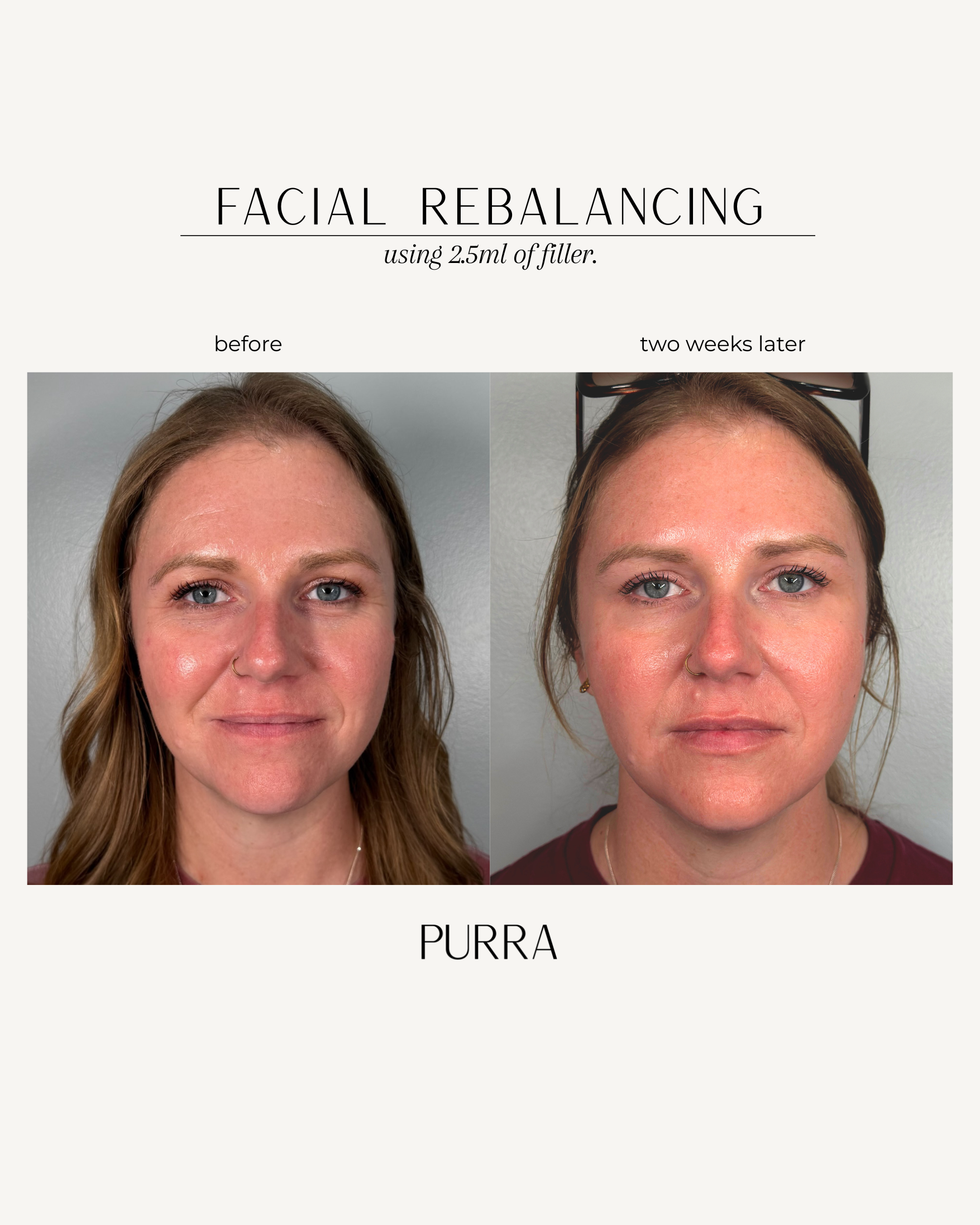 Facial balancing before and after at Purra MedSpa, Dillsburg PA