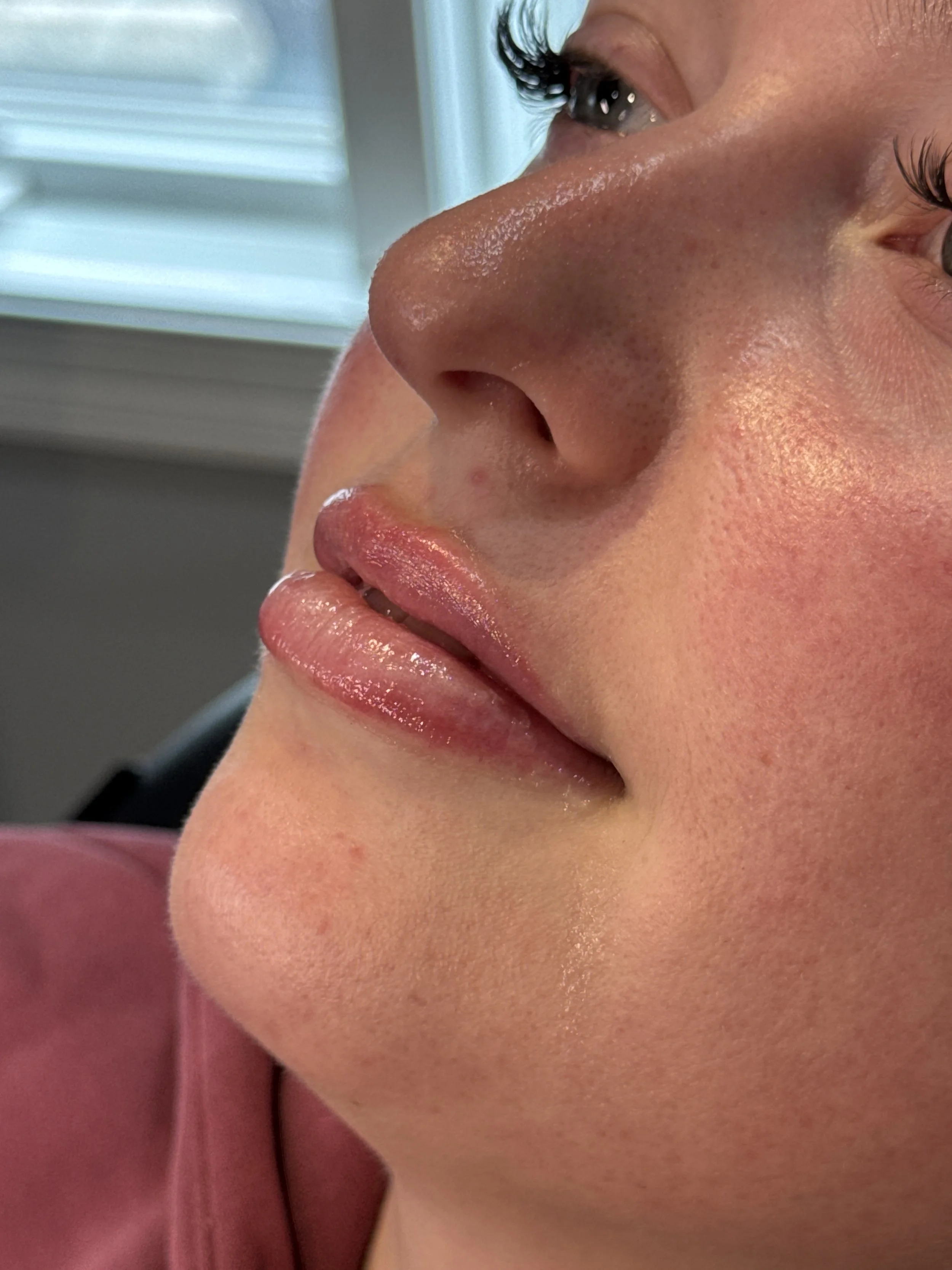 Signature natural lip filler by Purra MedSpa, Dillsburg Pennsylvania"
