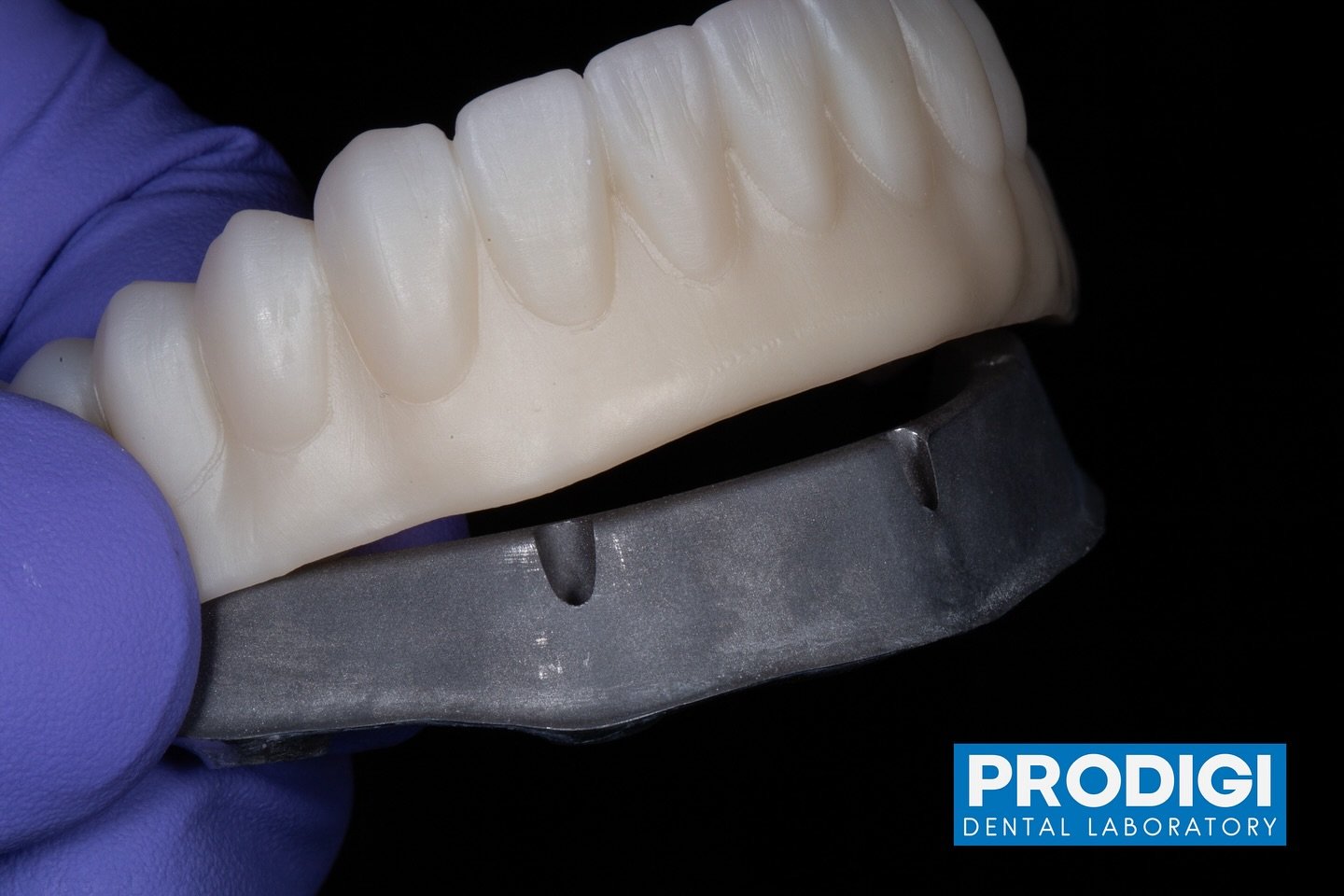 All-on-X with a titanium bar and zirconia overlay—crafted for optimal weight, longevity, and unmatched versatility.
Transforming smiles, redefining standards.
#ProdigiDentalLab #AllOnX #ZirconiaProsthetics #TitaniumBar #ImplantProsthetics #Smi