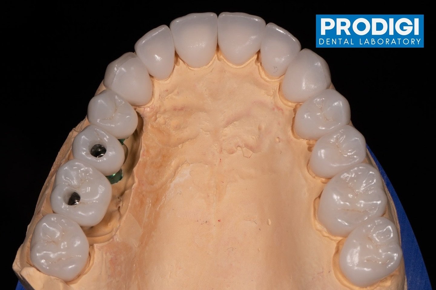 Upper arch reconstruction.
Zirconia + layered ceramic.
Implant restorations in posteriors.
Always pushing for excellence—for our doctors and their patients.
#FullMouthRehab #ZirconiaRestoration #LayeredCeramics #ImplantDentistry #UpperArchRec