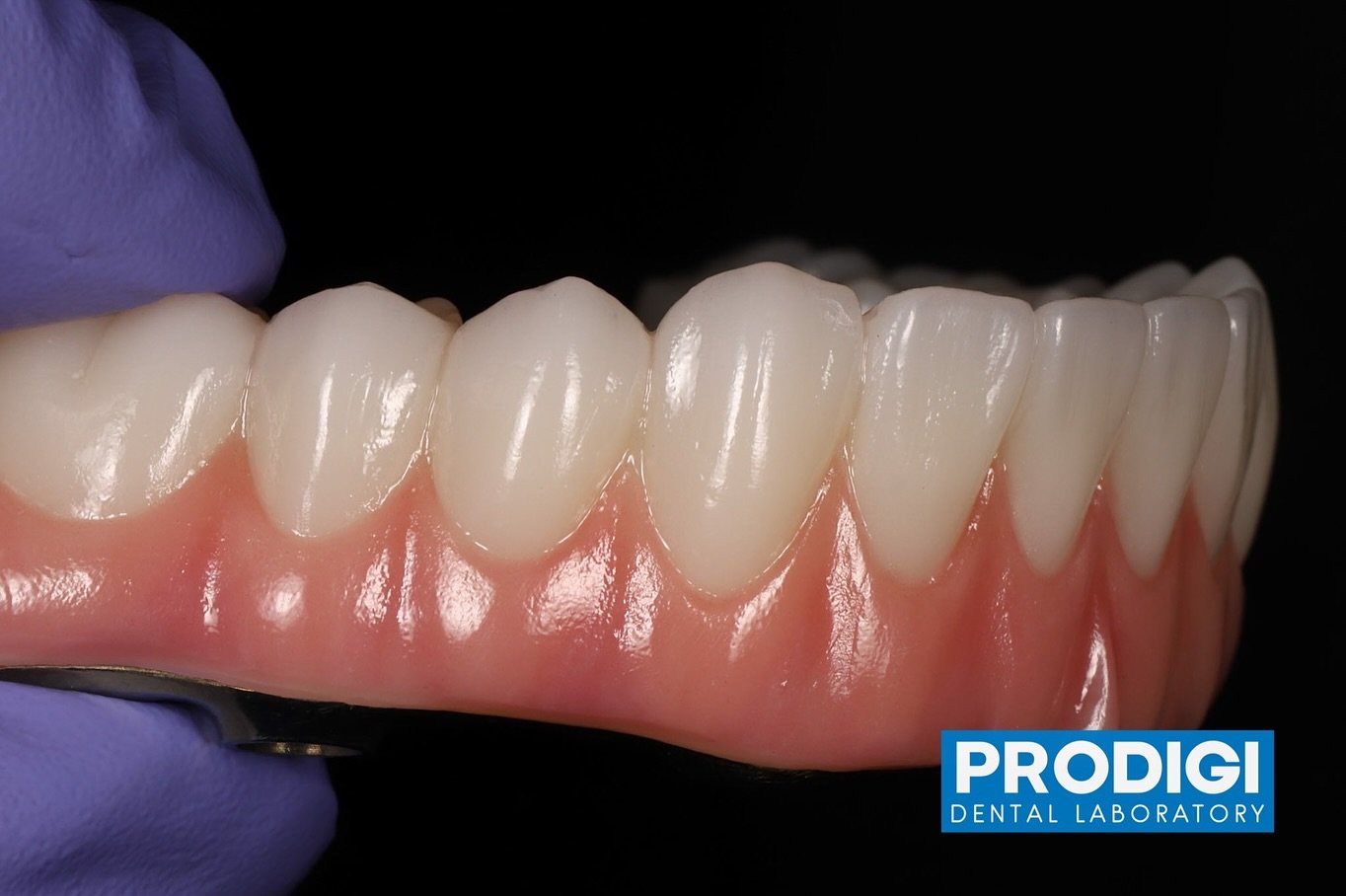 Functional, Beautiful, Made to Last.
All-on-X prosthetics with titanium bar reinforcement.
@prodigi_dentallab
With @dr_djshin @prostho.dental