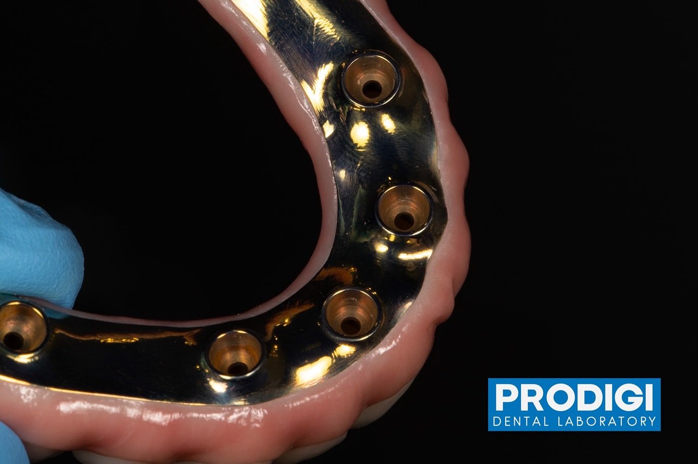 Titanium reinforced all-on-6 prosthetic
Zirconia overlay with buccal micro layered ceramics
@prodigi_dentallab