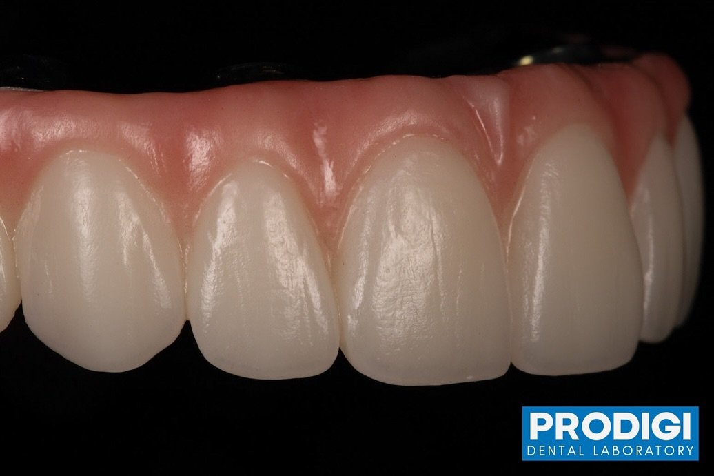 Replicating natural esthetics using zirconia with anterior cutback and layered ceramics.
All-on-x with titanium reinforcement
@prodigi_dentallab