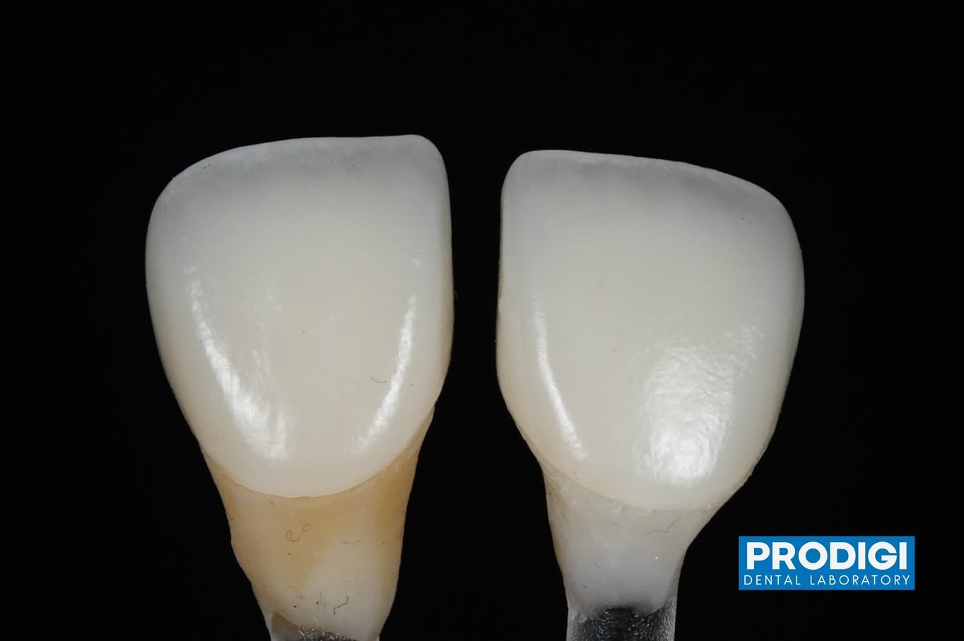 Anterior shade matching using Lithium Discilicate.
@prodigi_dentallab
