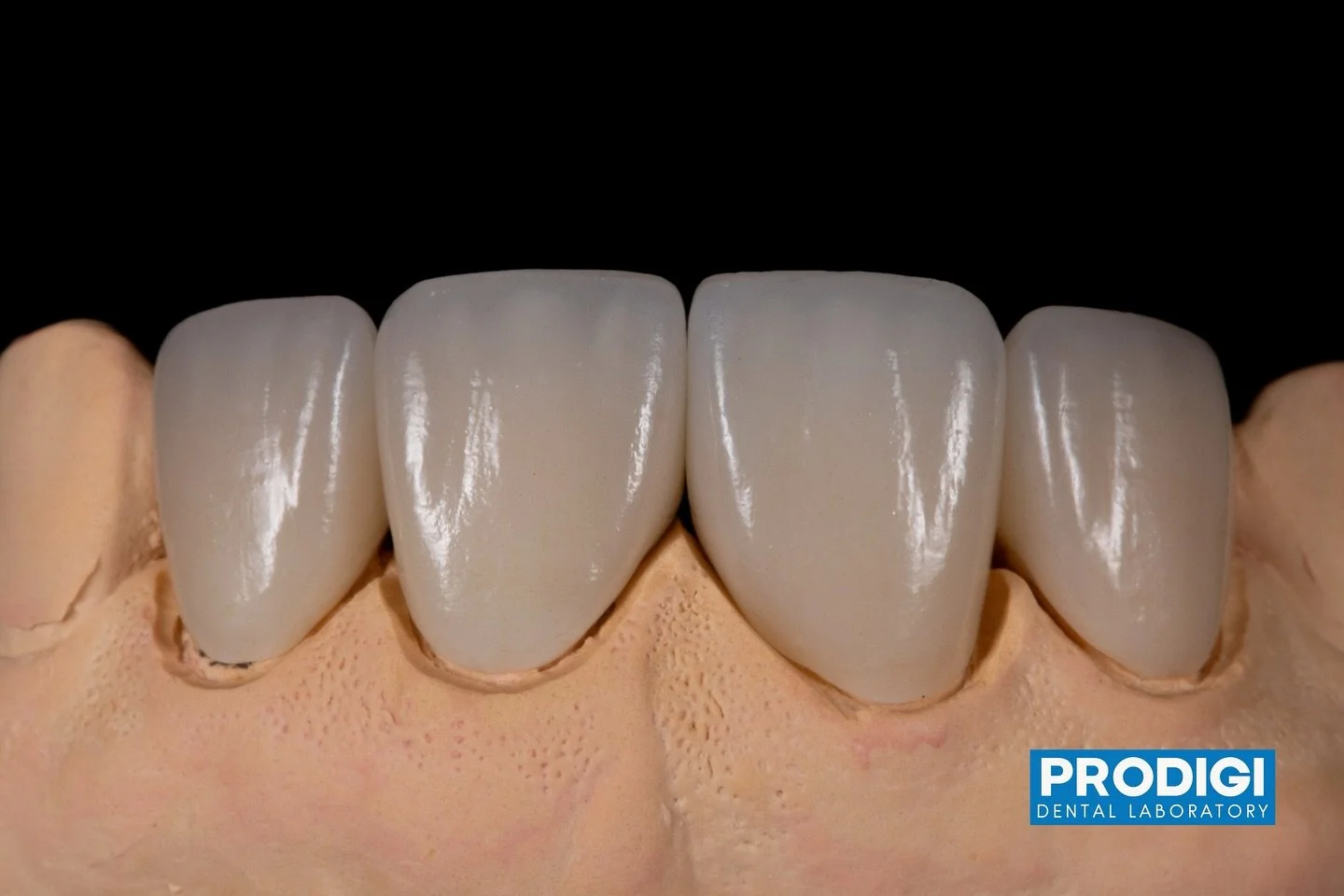 Prosthetic solution for width discrepancy for better aesthetic symmetry.
.
With @prostho.dental
@dr_djshin