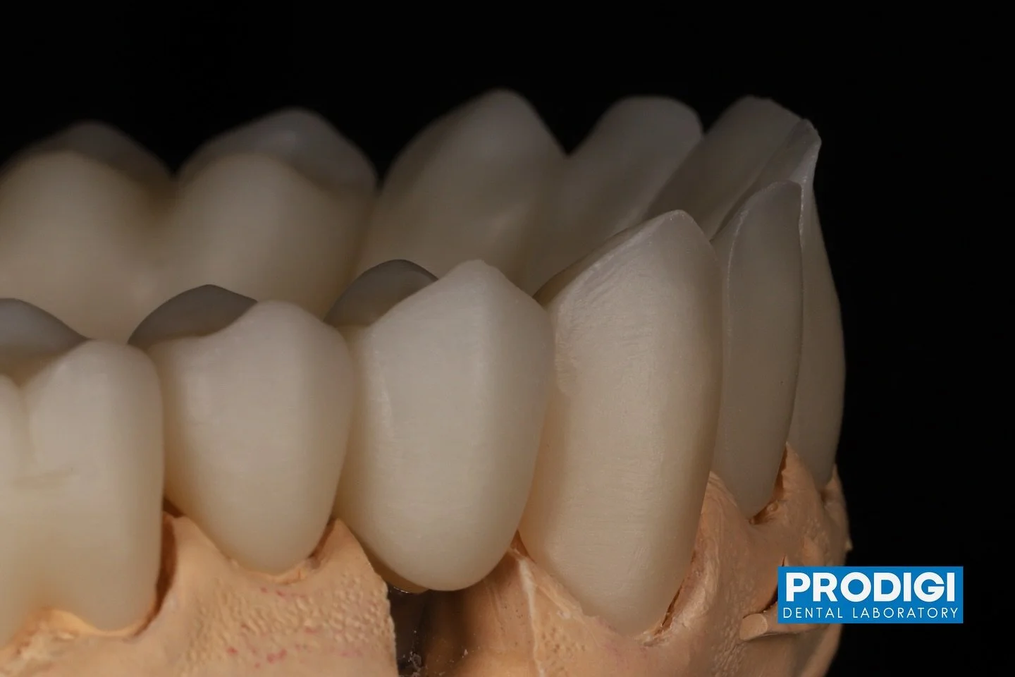 Zirconia coping cut back for the ceramic layering work, for hat ideal aesthetic look.
.
With @dr_djshin