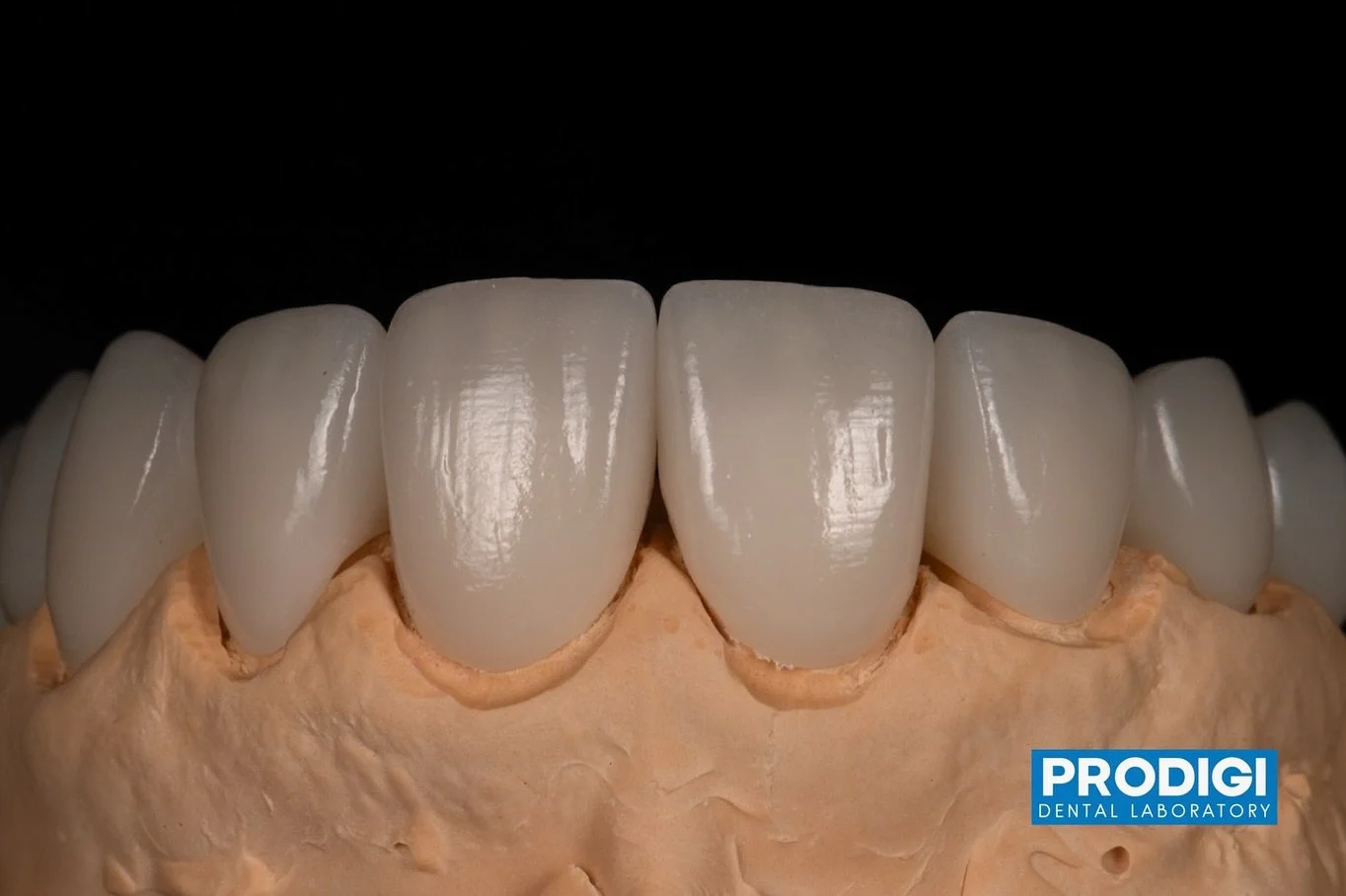 Full rehab ceramic work with @dr_djshin
Communication was key in this case.
Loving what we do. 😊
.
#ProdigiDentalLab #FullMouthRehab #DigitalDentistry #CeramicExcellence #dentallablove
