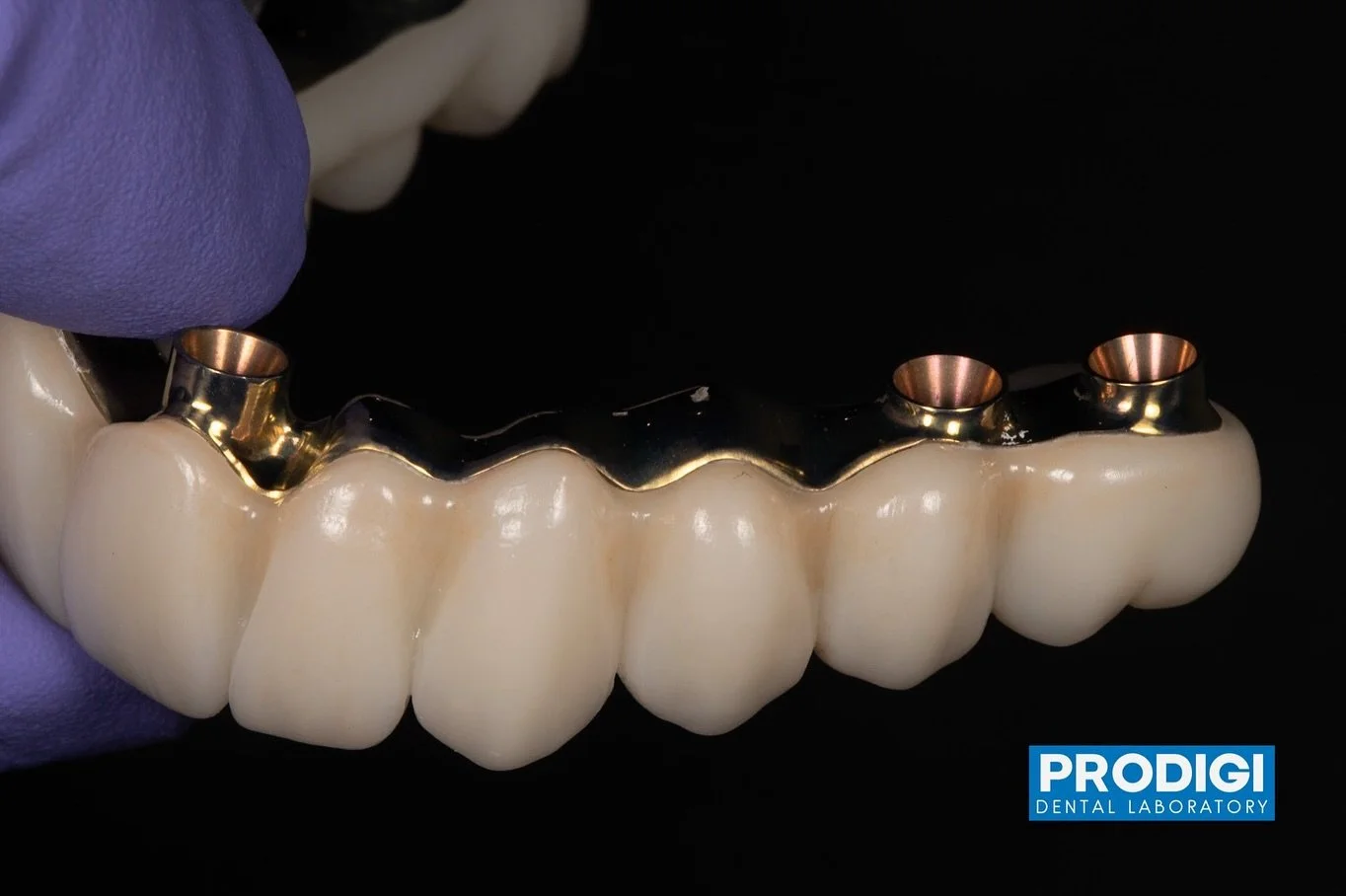 This case was particularly a challenge to solve aesthetics using prosthetic solutions.
Hard work with @dr_djshin
And we are so proud of the result!!
#prosthodontics #allonx #implantdentistry #prodigilab #dentallaboratory #dentallab #digitaldentalla