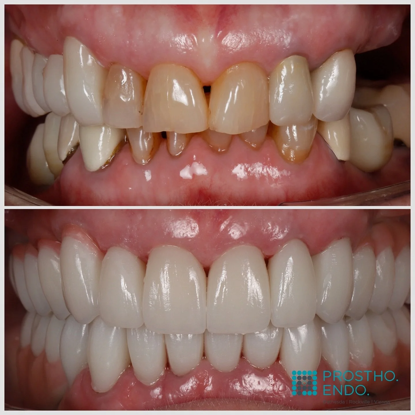 Complete rehab ceramic work with @prostho.dental
Always rewarding to see our work being seamlessly delivered by our partnering doctors. @dr_djshin
Truly a Life changing result!