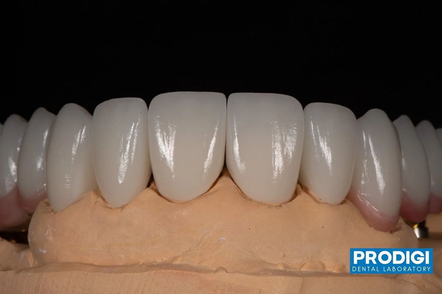 Full rehab ceramics
With @dr_djshin @prostho.dental